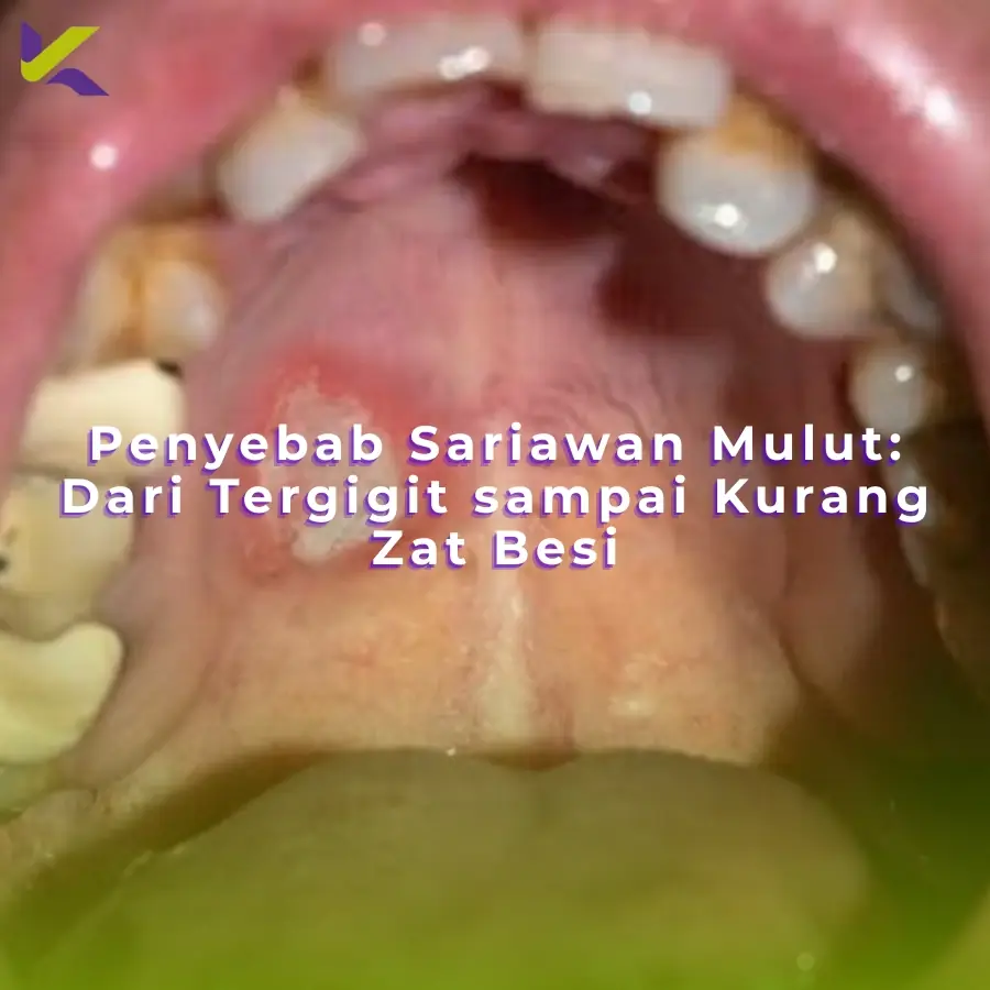 Penyebab Sariawan Mulut: Dari Tergigit sampai Kurang Zat Besi